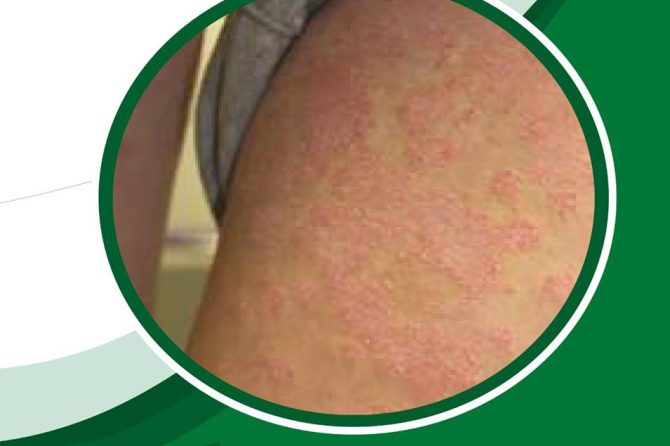 An Exclusive Complete Skin Detoxification Treatment for Psoriasis,Eczema and All Skin Diseases at Atharva Ayurveda…